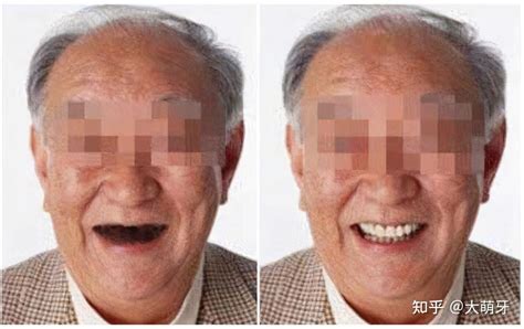 65岁老人种牙