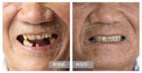 88岁老人可以种牙