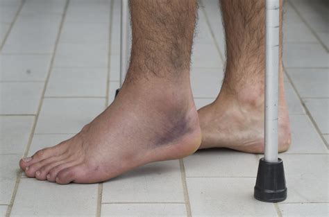 a sprained ankle