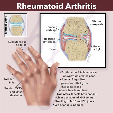 arthritisisadisease