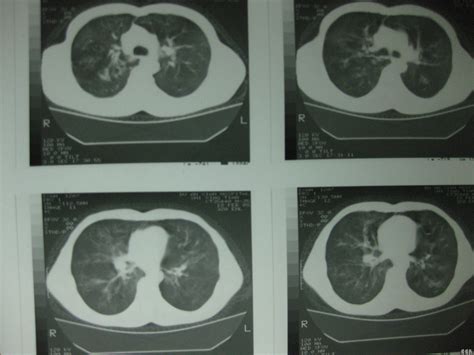 ct肺部检查的暗语
