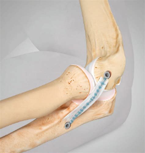 elbow repair