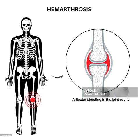 hemoarthritis