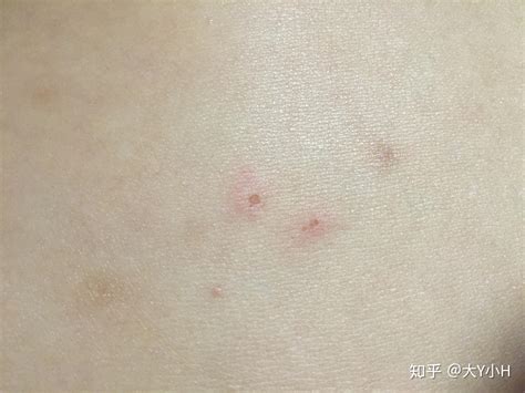 hiv引起丘疹性荨麻疹