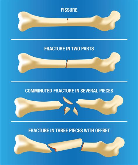 looking after tiny fractures