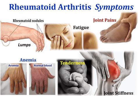 symptoms of mild arthritis