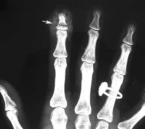 terminal fracture