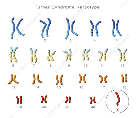 turnerssyndrome是遗传性疾病吗